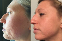Load image into Gallery viewer, Radiofrequency (RF) Microneedling Package of 3 Sessions
