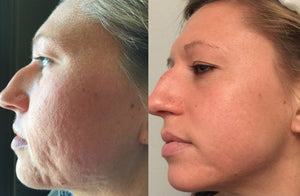 Radiofrequency (RF) Microneedling Package of 3 Sessions